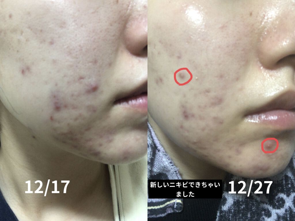 ドクタージャルト シカペア リカバー (第2世代）/Dr.Jart＋/フェイスクリームを使ったクチコミ（2枚目）