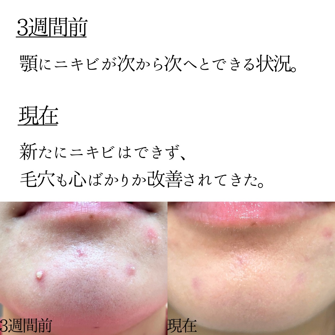 マジックティーツリーオイル/ブラン/フェイスオイルを使ったクチコミ（2枚目）