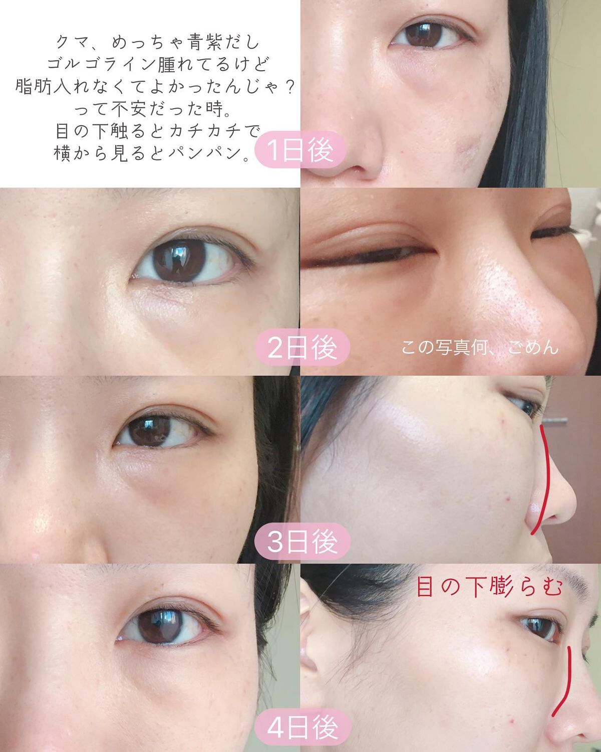 ぴーちゃん🧡インスタでコメント返信 on LIPS 「クマ取り体験談/┈┈┈┈┈┈┈┈┈┈ストーリーズにダウンタイム..」(7枚目)