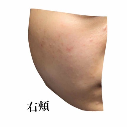 のん on LIPS 「汚肌を晒してごめんなさい🙇♀️🙇♀️中学校3年生後半から大..」(4枚目)