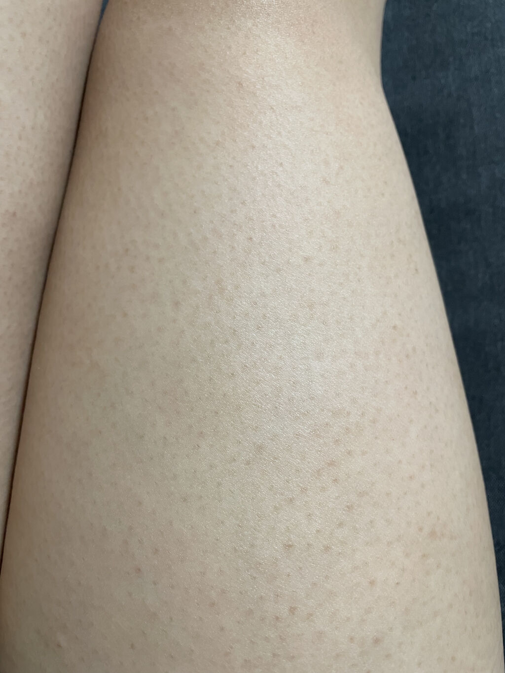 アイスレディ/icelady/家庭用脱毛器を使ったクチコミ（3枚目）