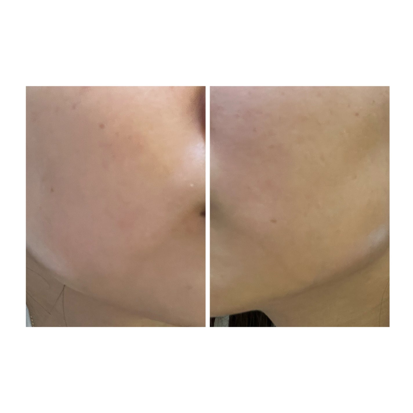 ぽむ on LIPS 「2023.9.13皮膚科に受診 エピデュオとヘパリン処方1枚目..」(5枚目)