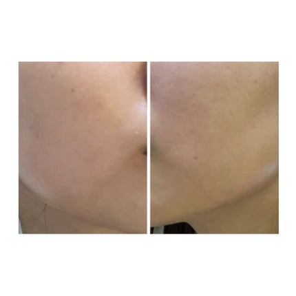 ぽむ on LIPS 「2023.9.13皮膚科に受診 エピデュオとヘパリン処方1枚目..」(5枚目)