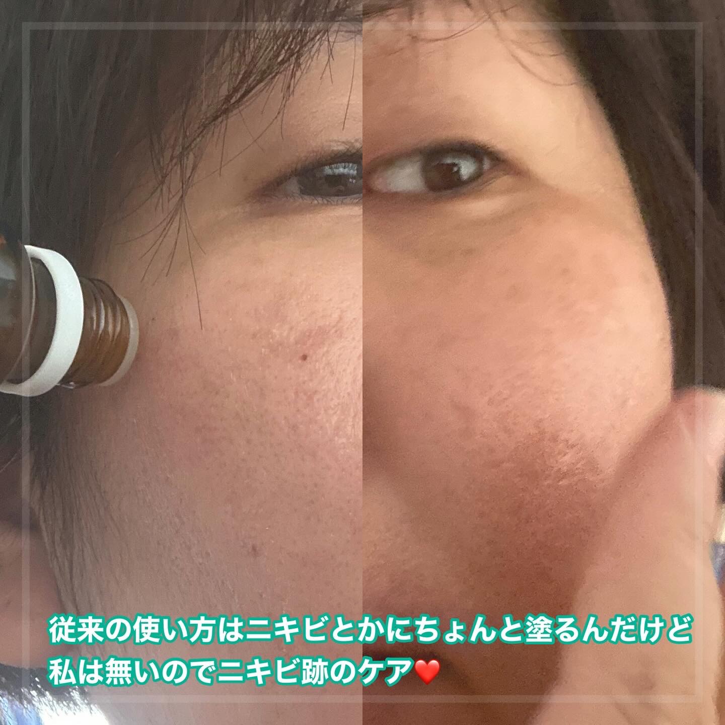 マジックティーツリーオイル/ブラン/フェイスオイルを使ったクチコミ（2枚目）