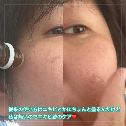 マジックティーツリーオイル/ブラン/フェイスオイルを使ったクチコミ(2枚目)