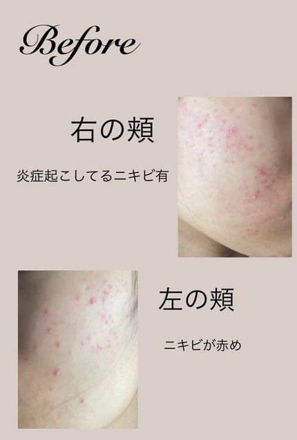 ゆるゆる on LIPS 「こんにちは〜☀️今日は皮膚科に行って貰った薬を1週間使った結果..」(3枚目)