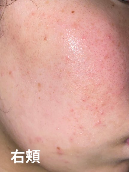 ビビ on LIPS 「顔面記録8日目就寝時間は覚えていない。起床8時朝は簡単に洗顔し..」(4枚目)