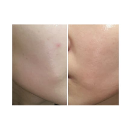 ぽむ on LIPS 「2023.9.13皮膚科に受診 エピデュオとヘパリン処方1枚目..」(4枚目)