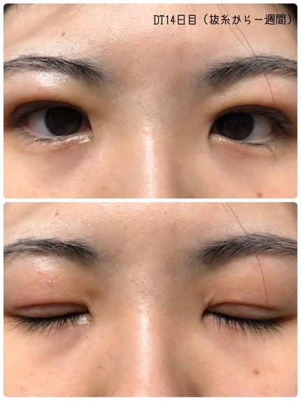 あーる@二重切開DT中 on LIPS 「【閲覧注意】二重整形(全切開)レポ-経過編-2月16日に二重整..」(8枚目)