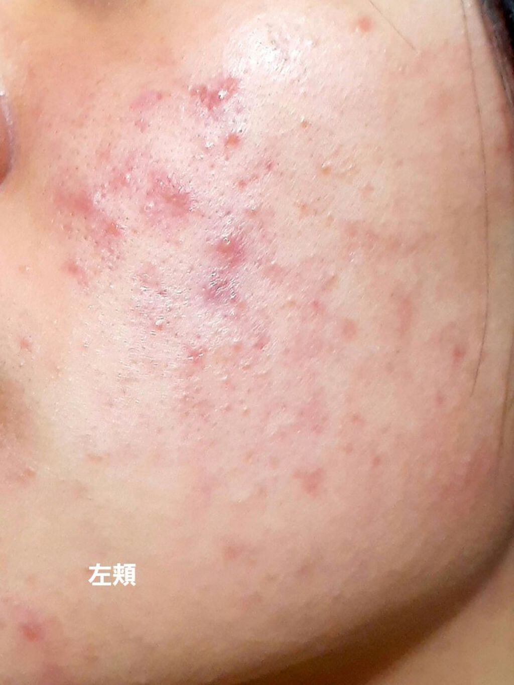 薬用アクネ ウォッシュ/クレンジングリサーチ/洗顔フォームを使ったクチコミ（2枚目）