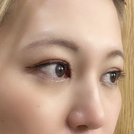 ふうせん @フォロバ100% on LIPS 「4月7日金曜日施術してから6週間が経ったよ❣️前回、1ヶ月検診..」(4枚目)