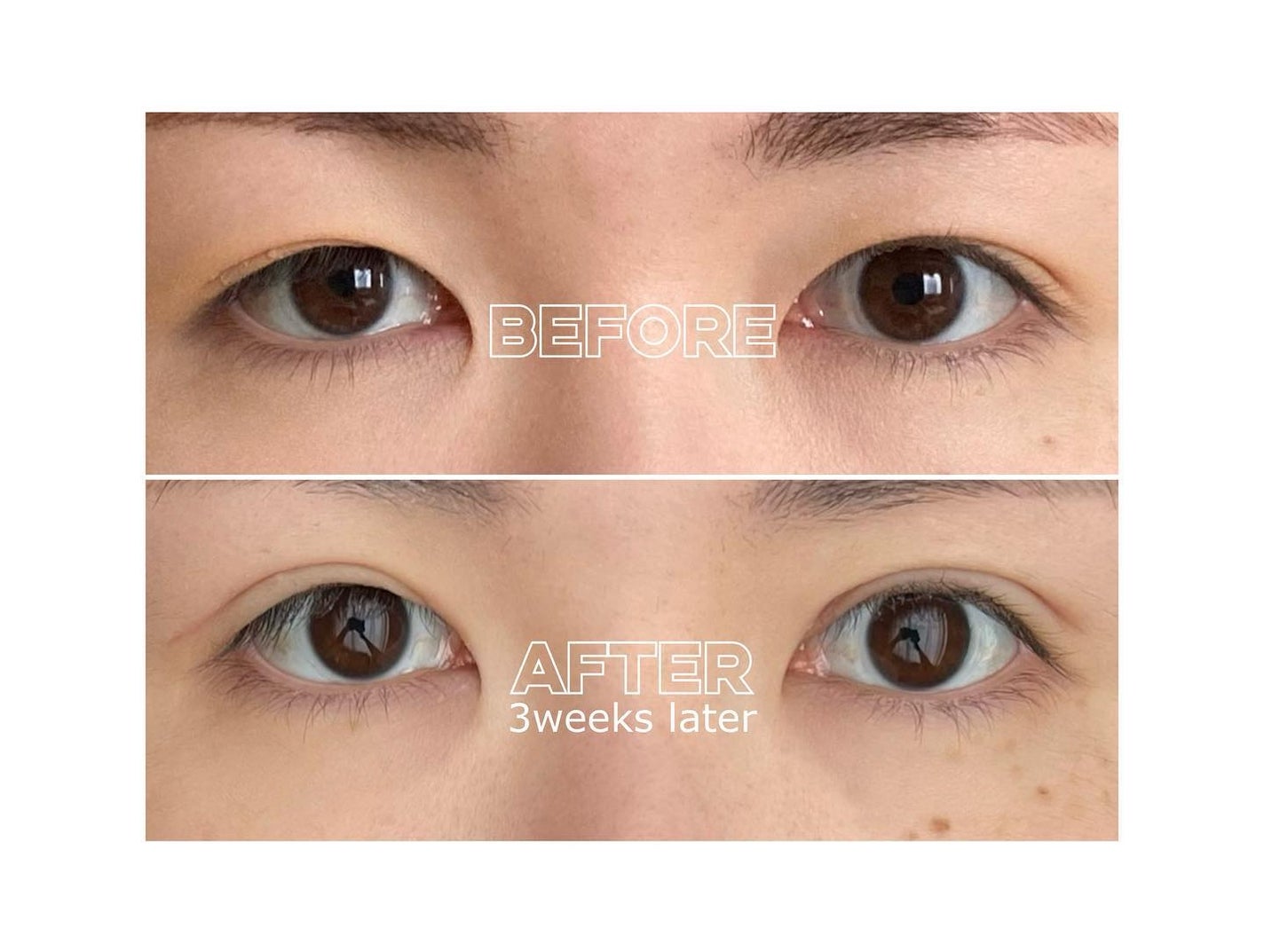 miyuki@PCアナリスト/コスメコンシェルジュ on LIPS 「実は!8月の上旬に上まぶたのたるみをとる手術を受けてきました✌..」(2枚目)