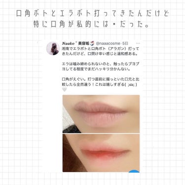 なーこ🫧ニキビ・肌荒れを美肌に on LIPS 「今日はボトックス打ってきたよ〜！の報告！⁡打って5日経ったので..」（2枚目）