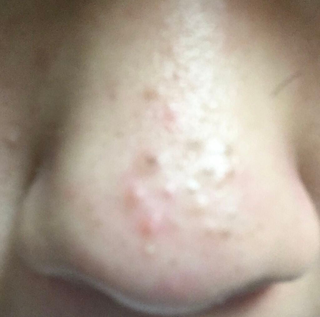 ããªðŠð on LIPS ãããããã®åç²§æ°Žãè¬æããŠãã ããïŒä»ã«ãæ²»ãæ¹æ³ã¯ããªãã§ã..ãïŒ1æç®ïŒ