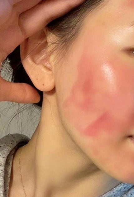 AHA 30% + BHA 2% Peeling Solution/The Ordinary/ピーリングを使ったクチコミ(2枚目)
