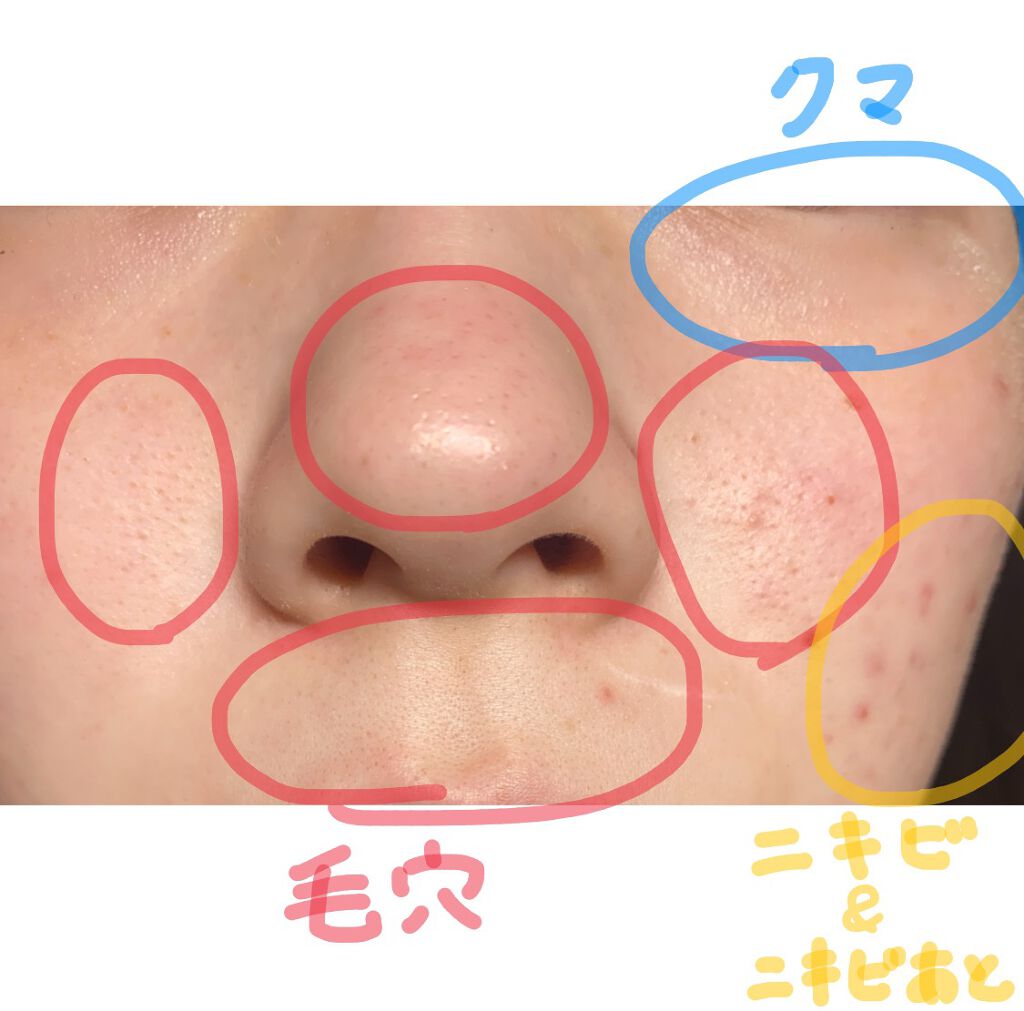 ルナ on LIPS 「ずっと肌の汚さで悩んでます!頬のニキビはマスクを着けるようにな..」(2枚目)