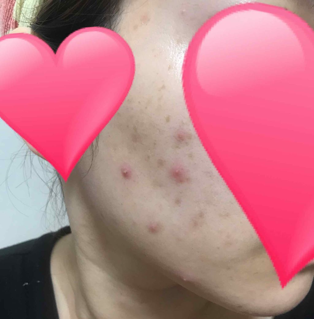 ハンガー on LIPS 「芯みたいなのは無くなったけど塗った瞬間からかゆみ!!2週間使っ..」(2枚目)