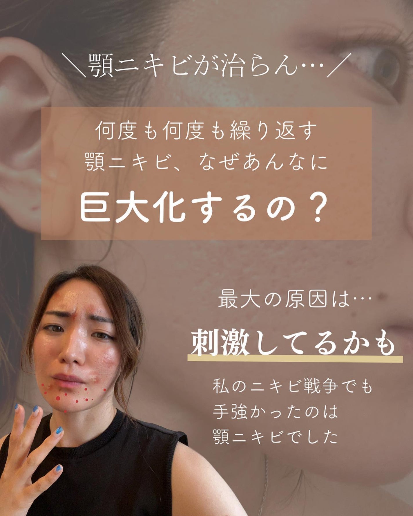 おゆみ|ニキビ・ニキビ跡ケア on LIPS 「【無意識に触ってない?】これに尽きる…!私もそうだったのですが..」(2枚目)