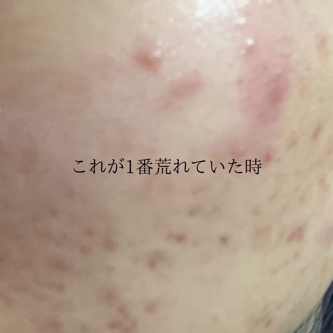 ハトムギ化粧水(ナチュリエ スキンコンディショナー R )/ナチュリエ/化粧水を使ったクチコミ（2枚目）