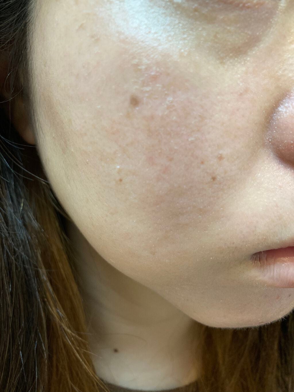 しい on LIPS 「カソーダ19日目昨日投稿し忘れた分です。皮むけがいっきに起こり..」(3枚目)