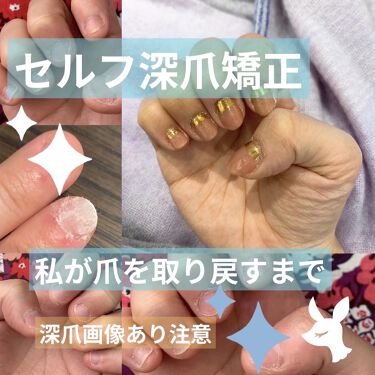 ジェルネイル ジェルミーワンを使った口コミ 深爪を治したい 噛み癖を治したいと思う方の By Miso Lips