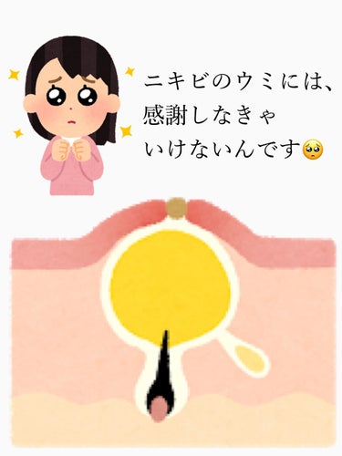 ｲｴﾍﾞちゃん🥰365日ｽｷﾝｹｱで脳がいっぱい on LIPS 「ふと、ニキビの白い部分てなんなんだろう？と思ったので調べてみま..」（1枚目）