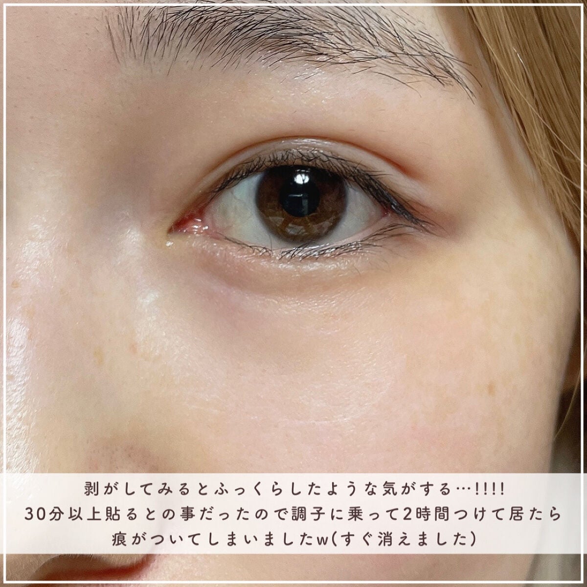 W+ マイクロ ニードル パッチ/SNP/アイケア・アイクリームを使ったクチコミ(7枚目)
