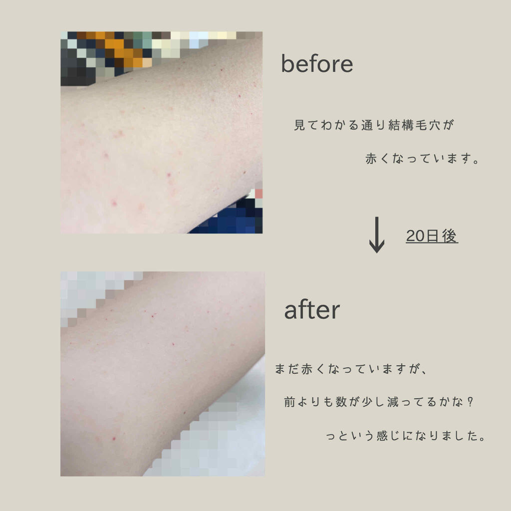 ニノキュア（医薬品）/ニノキュア/その他を使ったクチコミ（2枚目）