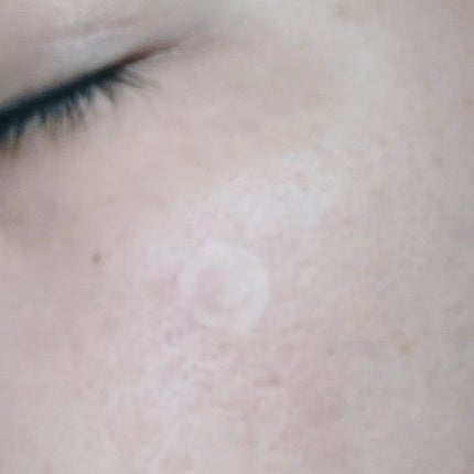 エイクリアスポットキュアパッチ/Dr.G/その他スキンケアを使ったクチコミ(4枚目)