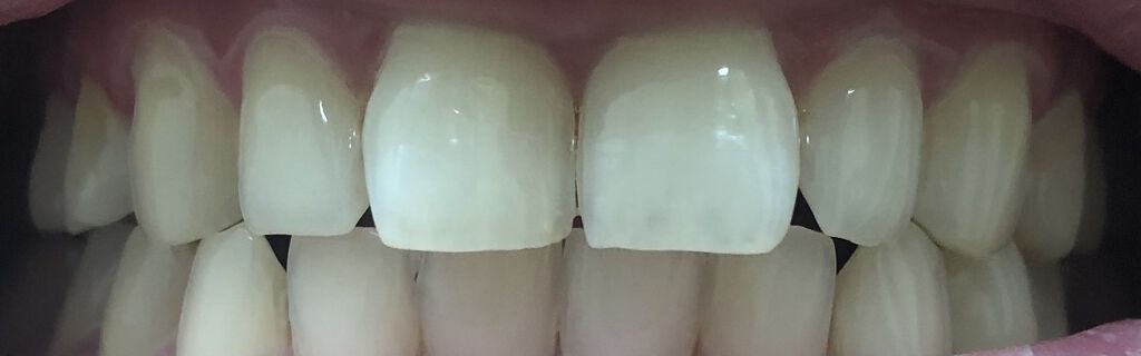 クレスト3Dホワイトニング ホワイトストリップ プロフェッショナル エフェクツ/クレスト/その他オーラルケアを使ったクチコミ（2枚目）