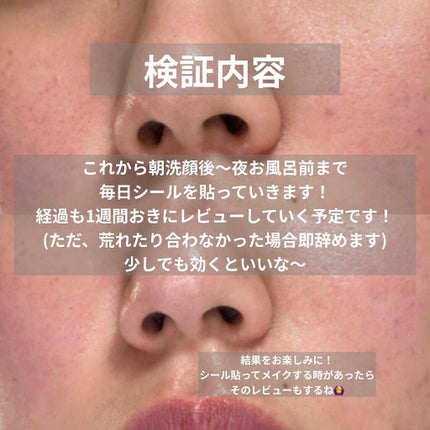 ハイドロコロイドスキンパッチ/ビューティーワールド/その他を使ったクチコミ(6枚目)