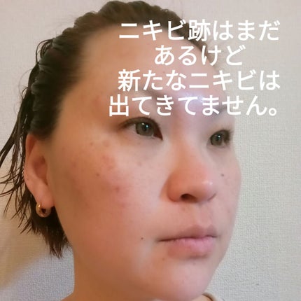 マジックティーツリーオイル/ブラン/フェイスオイルを使ったクチコミ(3枚目)