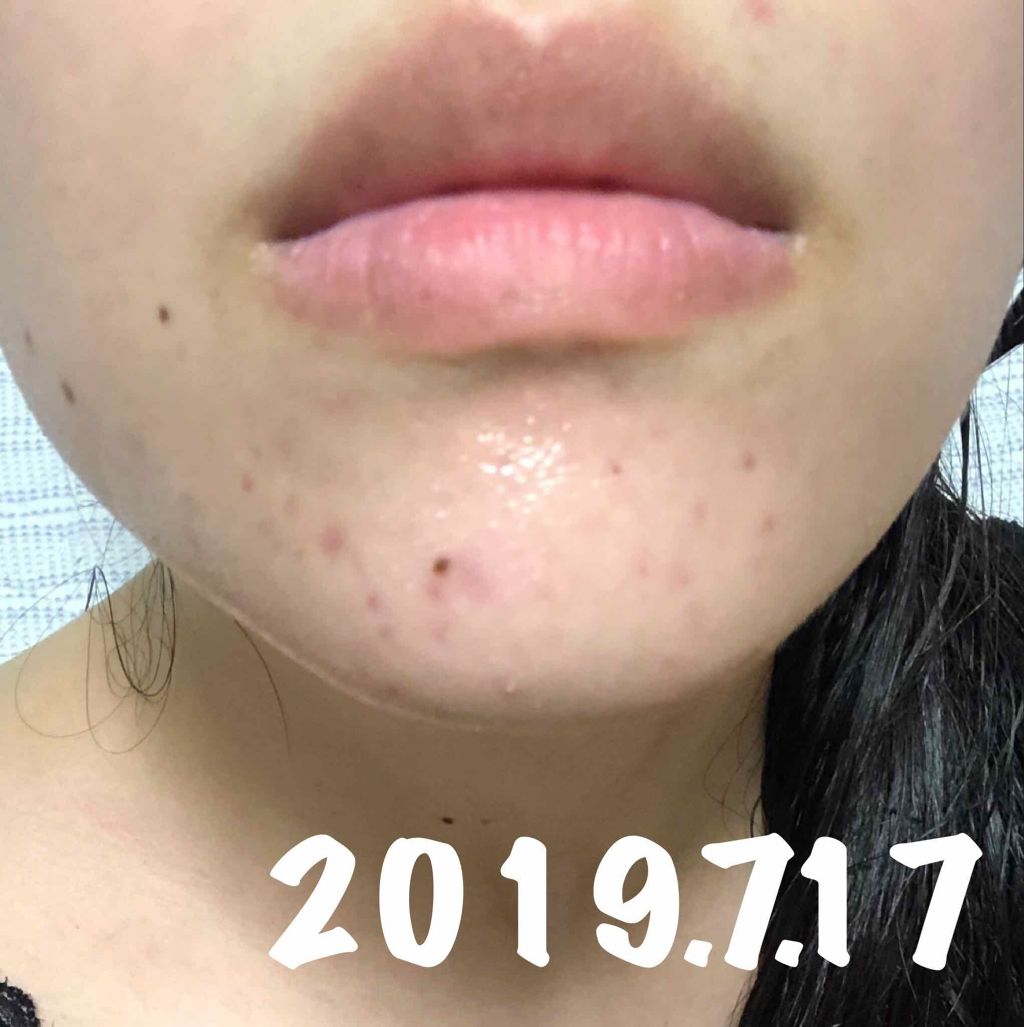 十味敗毒湯 ジュウミハイドクトウ(医薬品)/クラシエ薬品/その他を使ったクチコミ(4枚目)