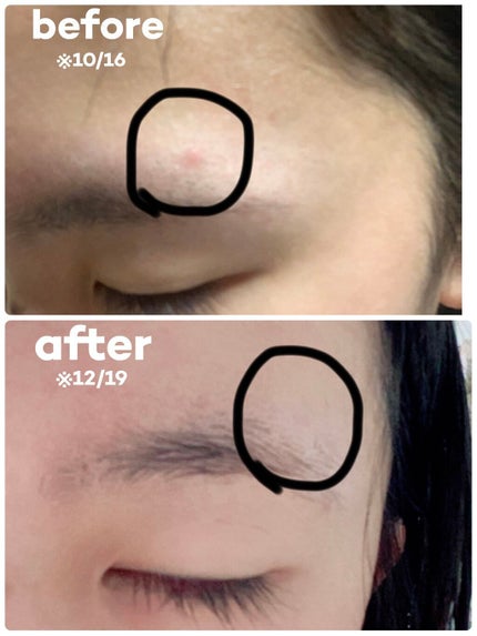 ペアアクネクリームW(医薬品)/ペア/その他を使ったクチコミ(5枚目)