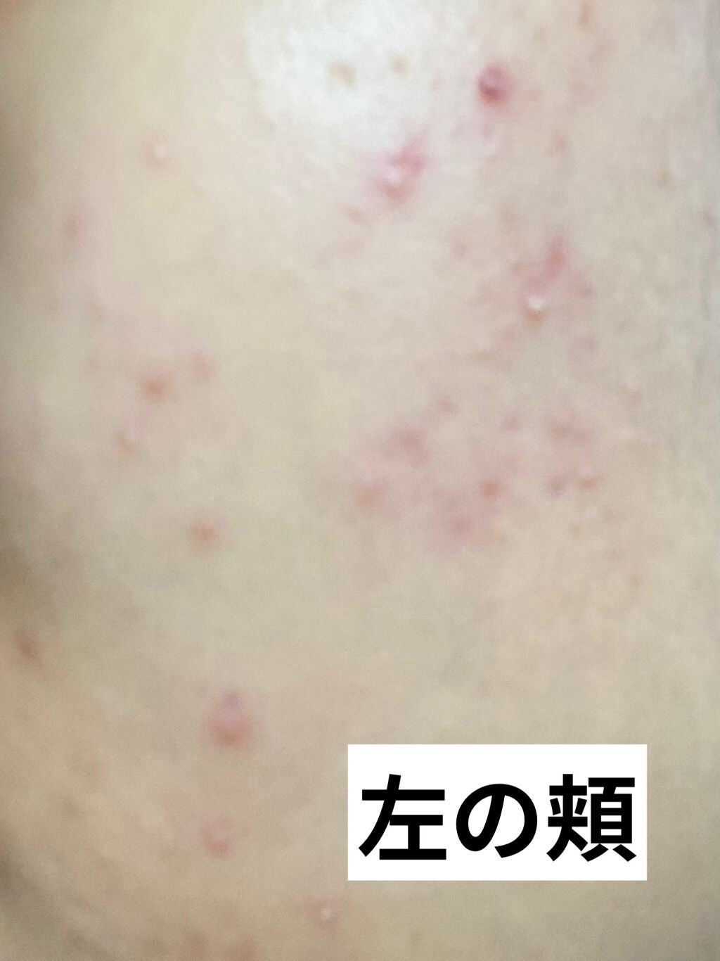 ロゼット洗顔パスタ アクネクリア/ロゼット/洗顔フォームを使ったクチコミ(3枚目)