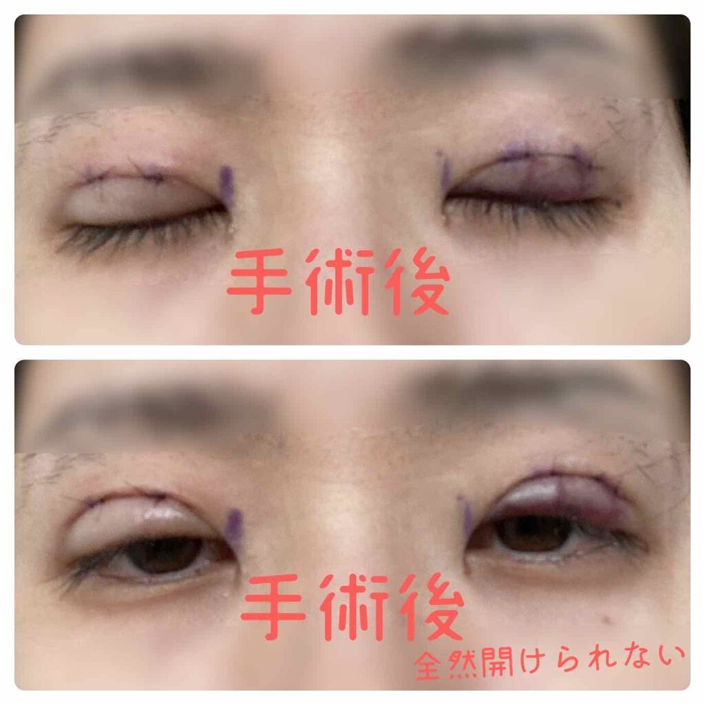 fantastic_blush_7x5 on LIPS 「こんばんは。二重手術(小切開法・部分切開法)術後1日目です。約..」(2枚目)