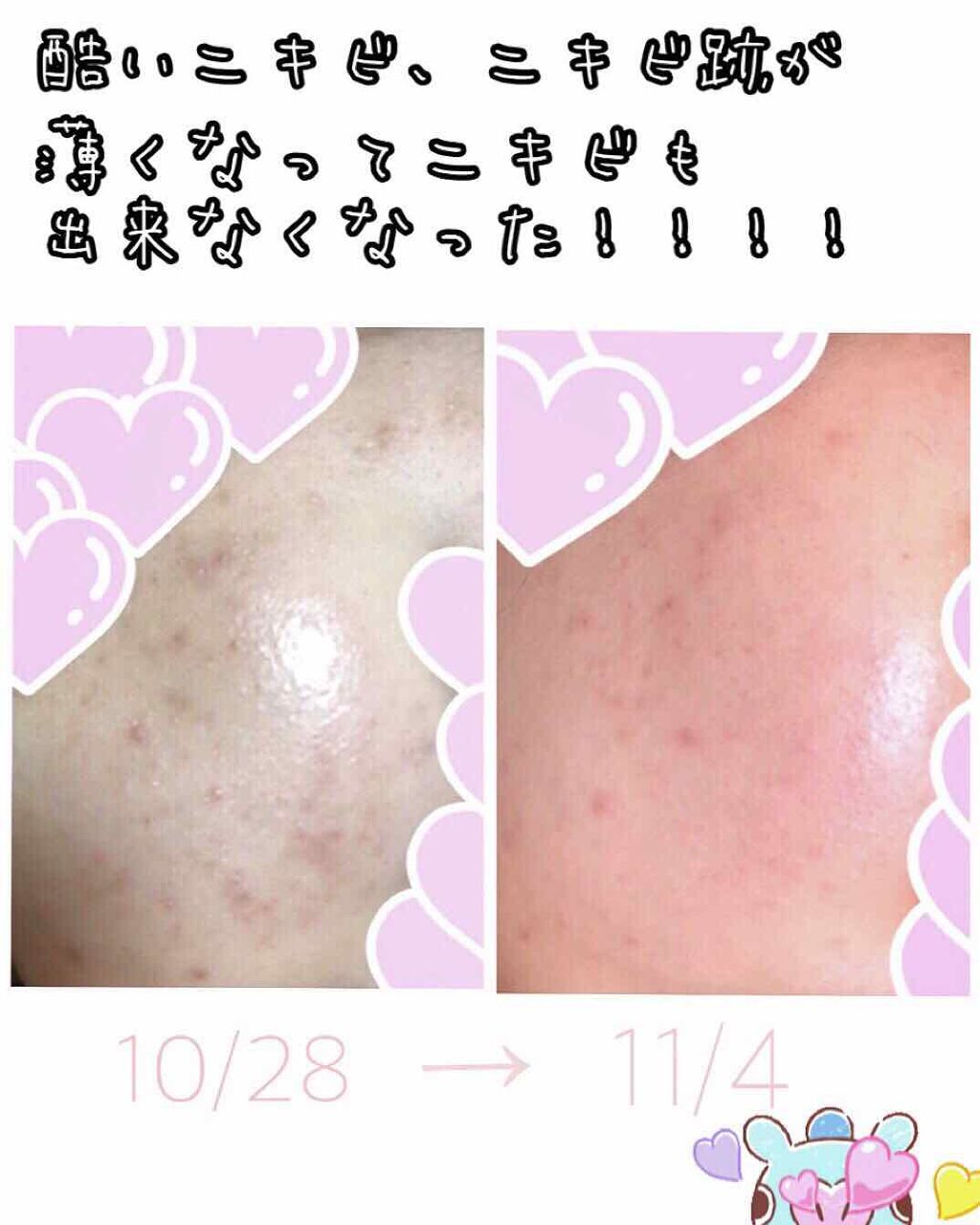 봉봉이॰˳ཻ̊♡ on LIPS 「肌荒れがたった8日で変わった!!!!!!!!最強のアイテムを紹..」(3枚目)