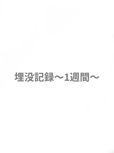 埋没レポ1週間

メイクもできるし腫れもないです。
内出血が消えれば完成だと思います❗️
メイク時間がめっちゃ短くなったし、アイプチ上手くいかないストレスない、埋没してよかった🥰


#週末二重術 
#