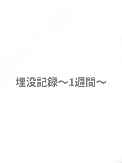 二重整形/その他を使ったクチコミ(1枚目)