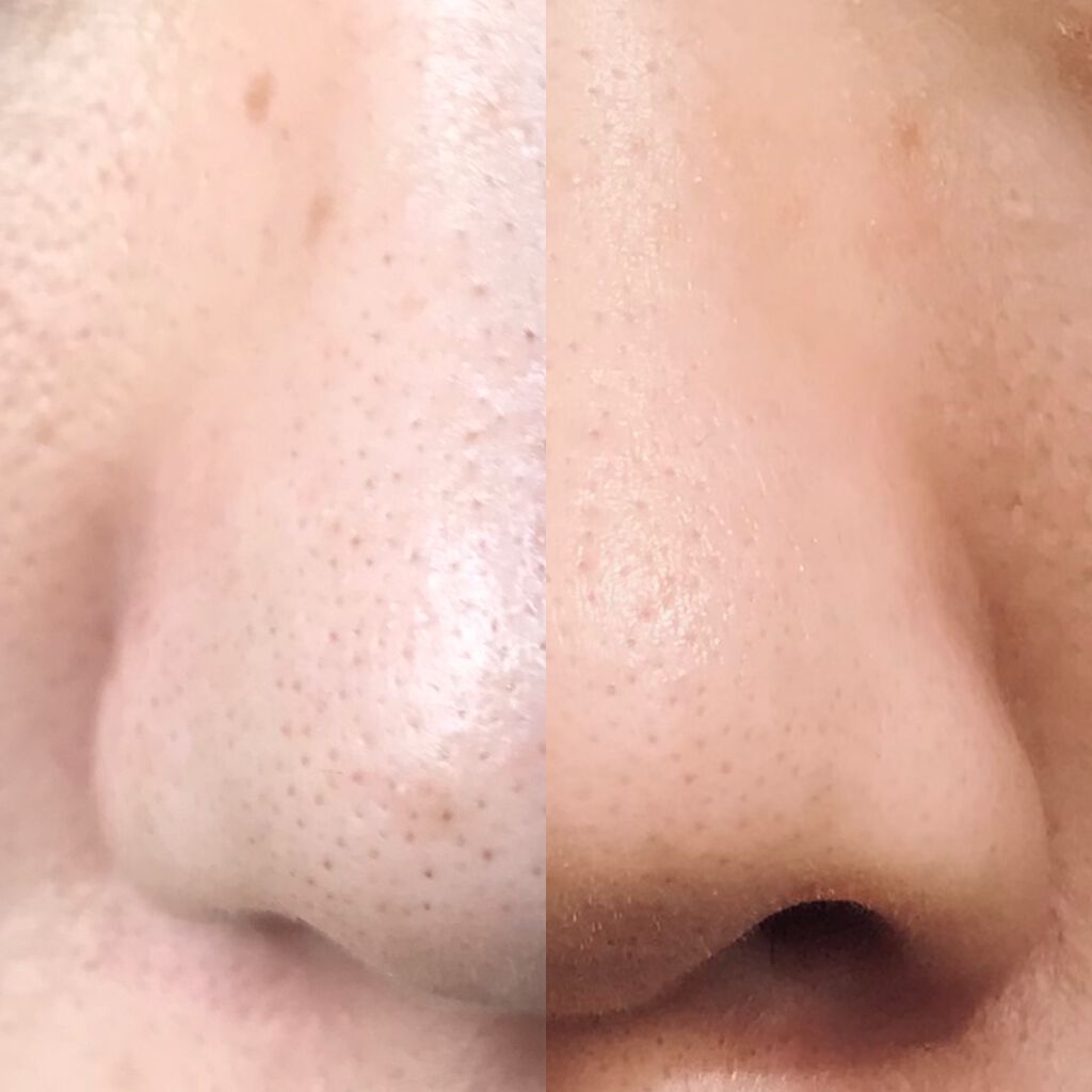 ノーモアブラックヘッド(ノーズピーリング)/One-day's you/スクラブ・ゴマージュを使ったクチコミ(2枚目)