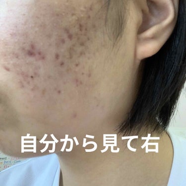 mei on LIPS 「前回の投稿を出してから皮膚科に行ったところ市販のものを使わない..」（1枚目）