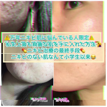 ジア:)脂性肌向け on LIPS 「🚨ニキビ写真あります🚨(恥ずかしいですが、⚠️万年ニキビ肌⚠️..」（1枚目）