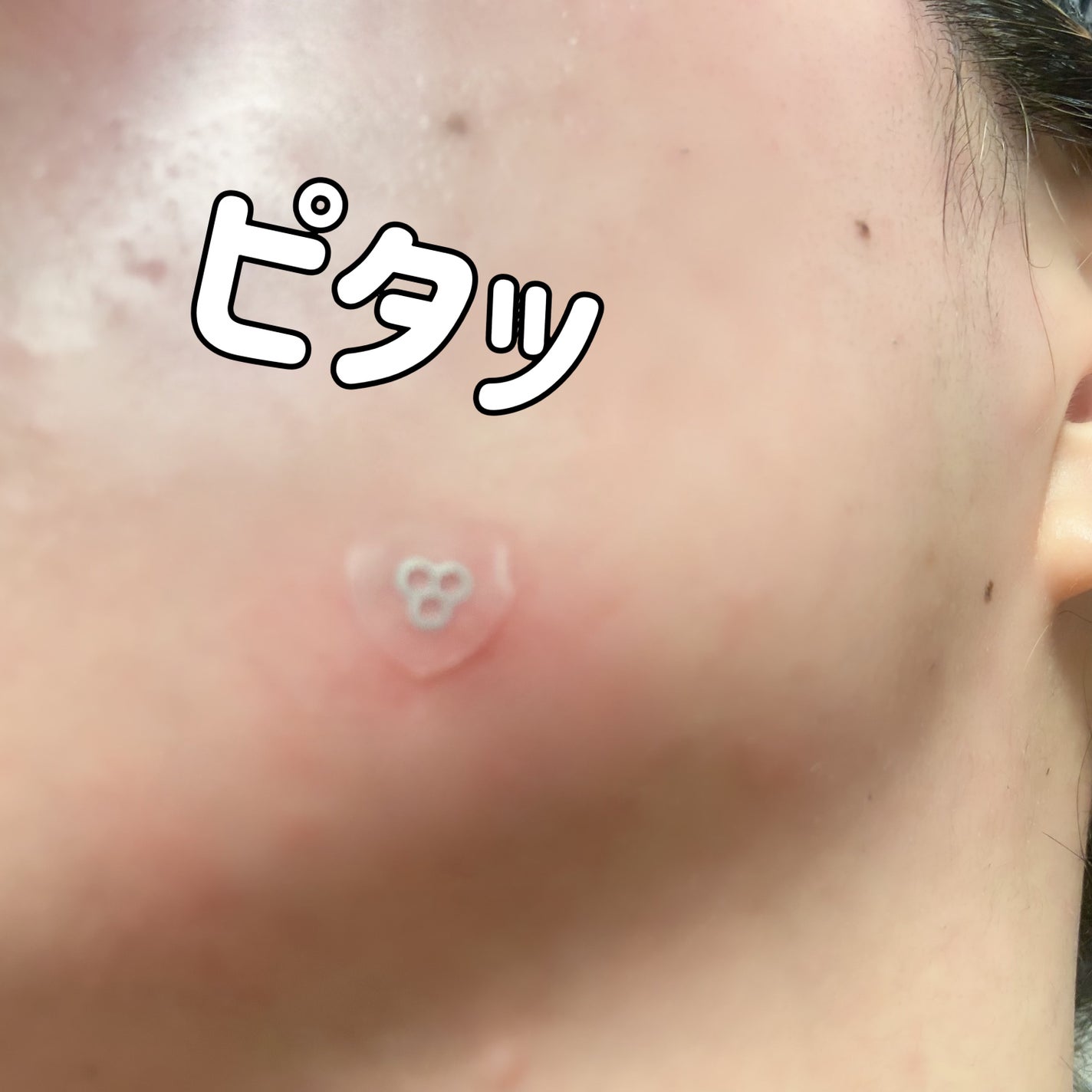 ACマグネシウムパッチ ミニ/スノーツープラス/にきびパッチを使ったクチコミ(5枚目)