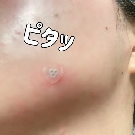 ACマグネシウムパッチ ミニ/スノーツープラス/にきびパッチを使ったクチコミ(5枚目)