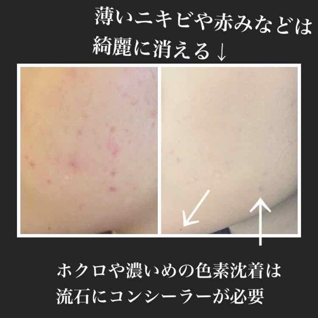 エクストラ リッチ クリーム ファンデーション Suqquの口コミ 汚い肌の写真もあるので観覧注意です By タミヤ 敏感肌 代前半 Lips