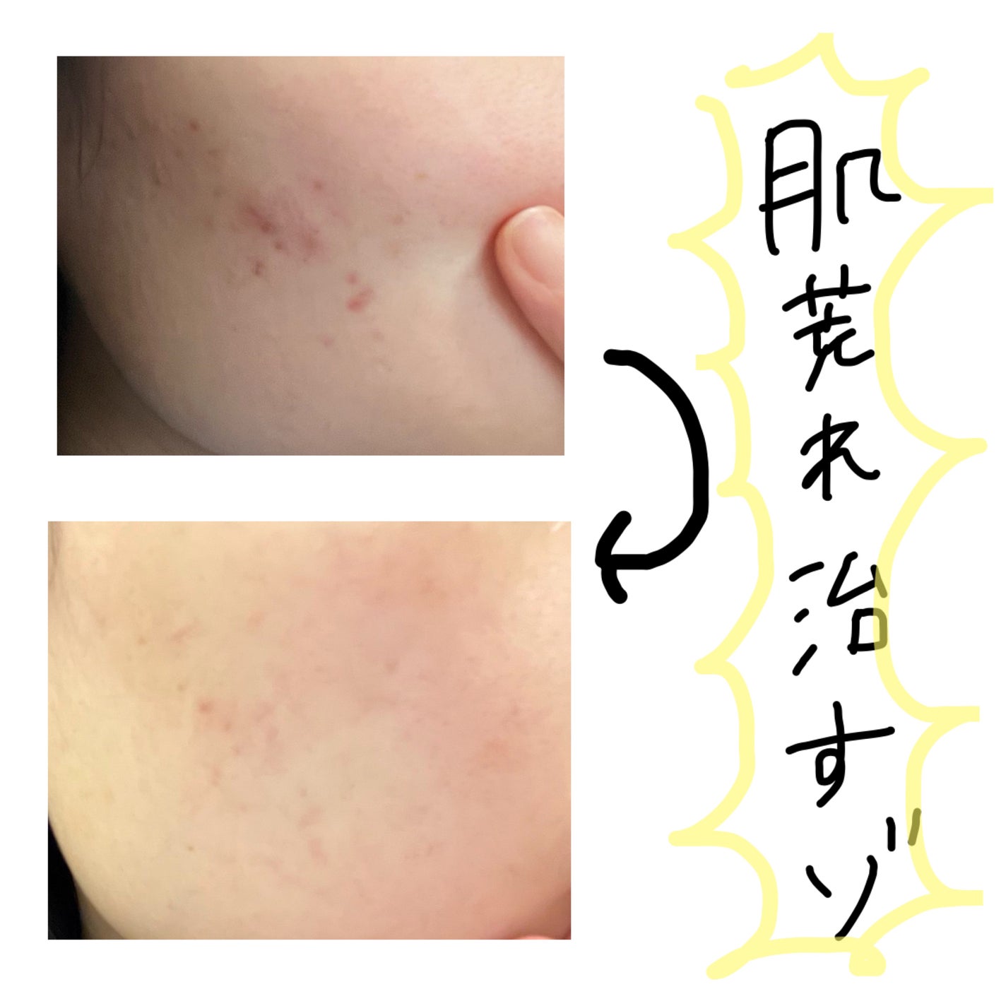 アポスティークリーム(医薬品)/アポスティー/その他を使ったクチコミ(1枚目)