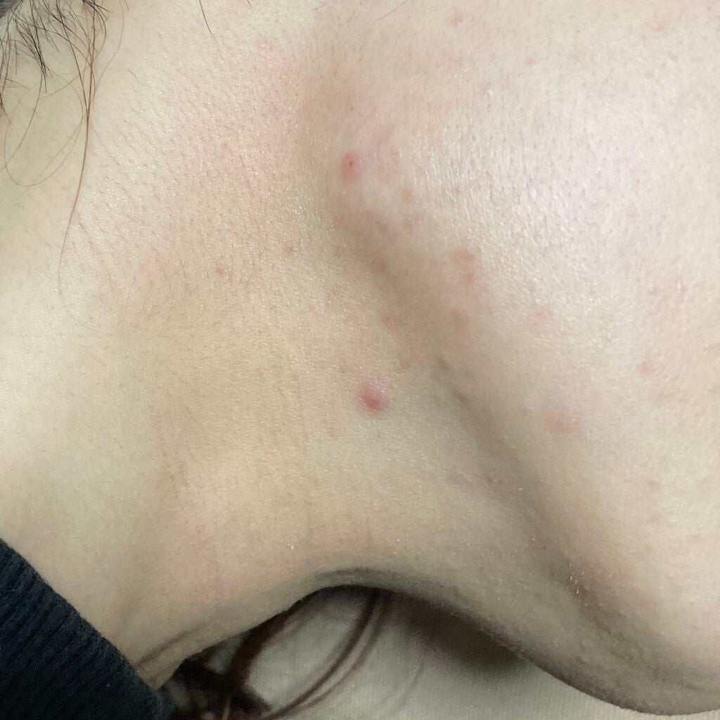 田中さんかく on LIPS 「ちょうど1ヶ月程前についに皮膚科へ行きました!!!!処方された..」(3枚目)