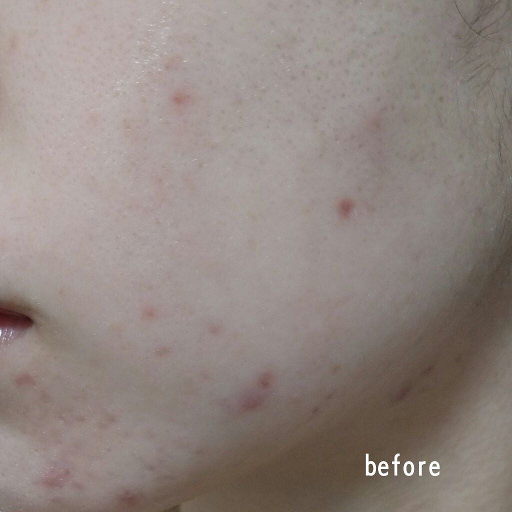 チョコラBBプラス (医薬品)/チョコラBB/その他を使ったクチコミ(3枚目)