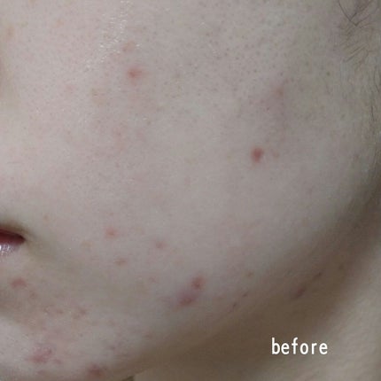 チョコラBBプラス (医薬品)/チョコラBB/その他を使ったクチコミ(3枚目)