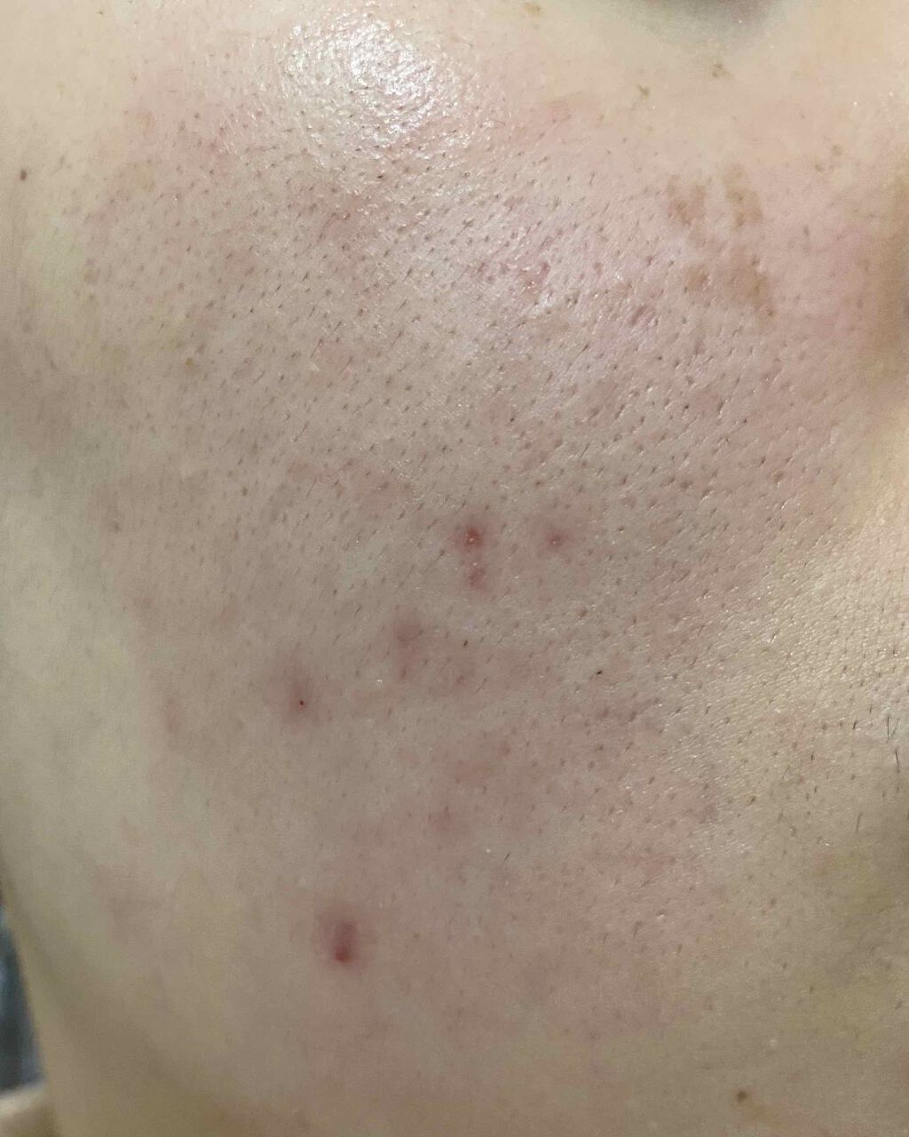 薬用アクネホワイトニング ジェル(部分用美容液)/DHC/美容液を使ったクチコミ(2枚目)